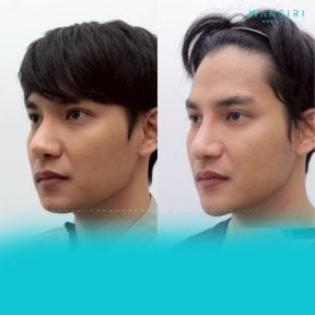 Facial masculinization surgery before and after results at Wansiri Hospital, enhanced jawline