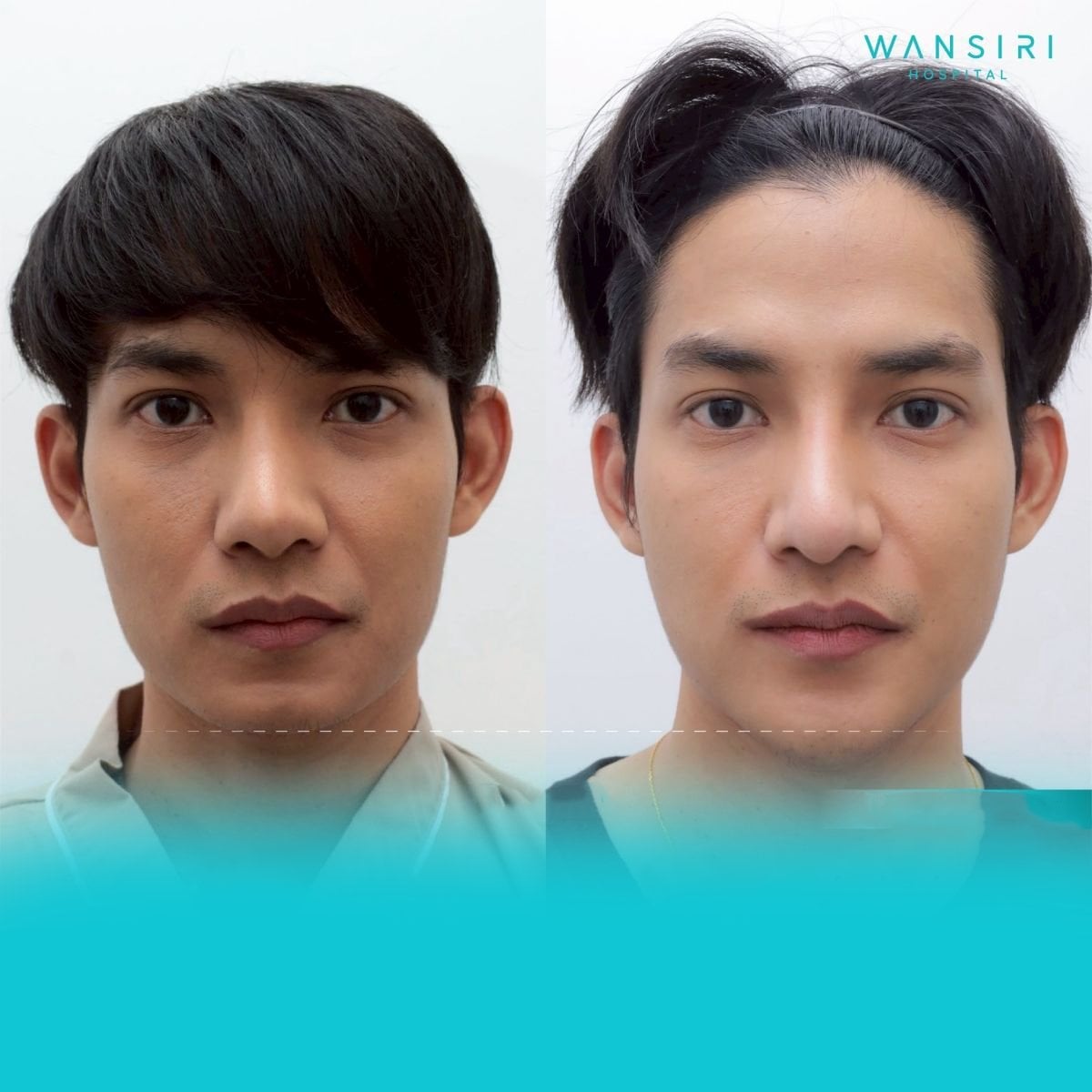 Resultados antes y después de masculinización facial en Wansiri Hospital, mandíbula definida