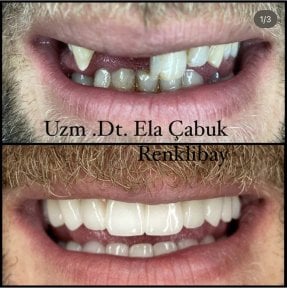 Результаты до и после имплантации зубов в частной клинике доктора Элы Чабук Ренклибай