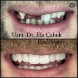 Результаты до и после имплантации зубов в частной клинике доктора Элы Чабук Ренклибай