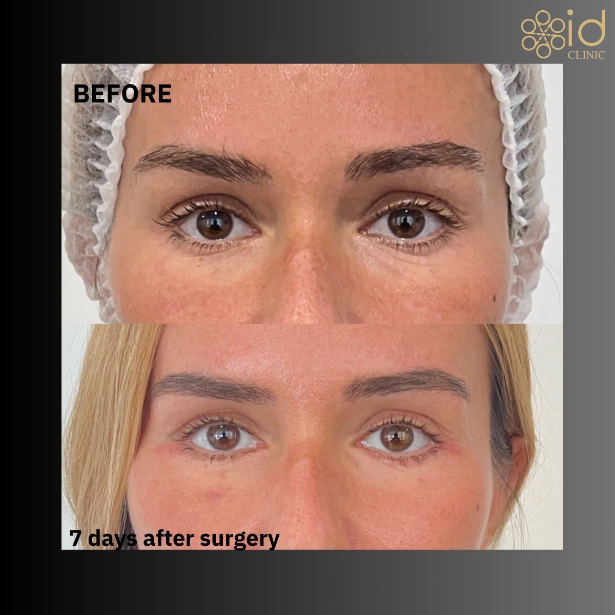 Vorher-nachher-Ergebnis Unterlid-Blepharoplastik bei ID Clinic Bangkok, 7 Tage post-op