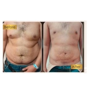 Before and after Vaser liposuction results at ID Clinic Bangkok, visible abdominal contouring
