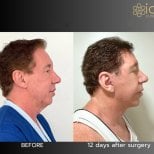 Before and after neck lift results at ID Clinic Bangkok, visible jawline and neck improvement