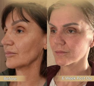 Vorher-nachher-Ergebnis Brauenlifting bei Dr. Safa Manav Clinic, sichtbare Anhebung