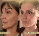 Vorher-nachher-Ergebnis Brauenlifting bei Dr. Safa Manav Clinic, sichtbare Anhebung