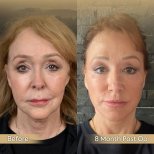 Vorher-nachher-Ergebnis der Brauenlifting-OP in der Dr. Safa Manav Klinik, 8 Monate postoperativ