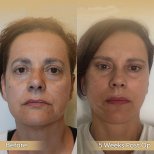 Vorher-nachher-Ergebnis Brauenlifting bei Dr. Safa Manav Clinic, Stirnverjüngung sichtbar