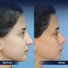 Vorher-nachher-Ergebnis der Nasenkorrektur in der Dr. Safa Manav Klinik, verbesserte Nasenform