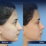Vorher-nachher-Ergebnis der Nasenkorrektur in der Dr. Safa Manav Klinik, verbesserte Nasenform