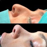 Vorher-nachher-Ergebnisse der Nasenkorrektur in der Dr. Safa Manav Klinik, verbesserte Nasenform