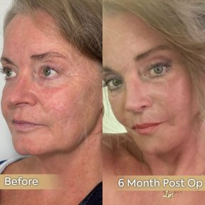 Vorher-nachher-Ergebnis Brauenlifting bei Dr. Safa Manav Clinic, 6 Monate postoperativ