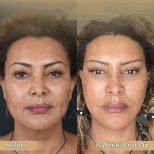Vorher-nachher-Ergebnis Brauenlifting bei Dr. Safa Manav Clinic, sichtbare Stirnstraffung