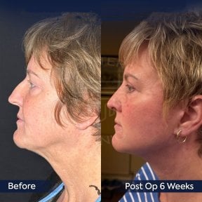 Результати підтяжки обличчя до і після в клініці Dr. Safa Manav, помітний ліфтинг шиї та щелепи