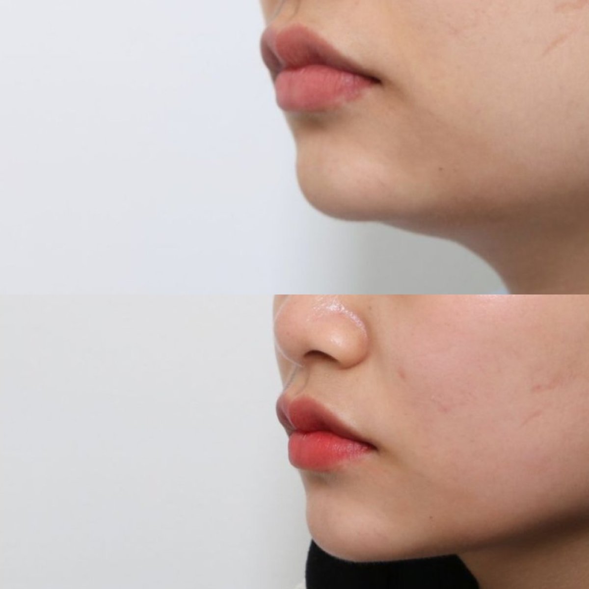 Resultado de liposucción de papada antes y después en URBAN Plastic Surgery, mandíbula definida