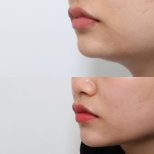 نتيجة شفط دهون الذقن المزدوج قبل وبعد في URBAN Plastic Surgery، خط فك محدد