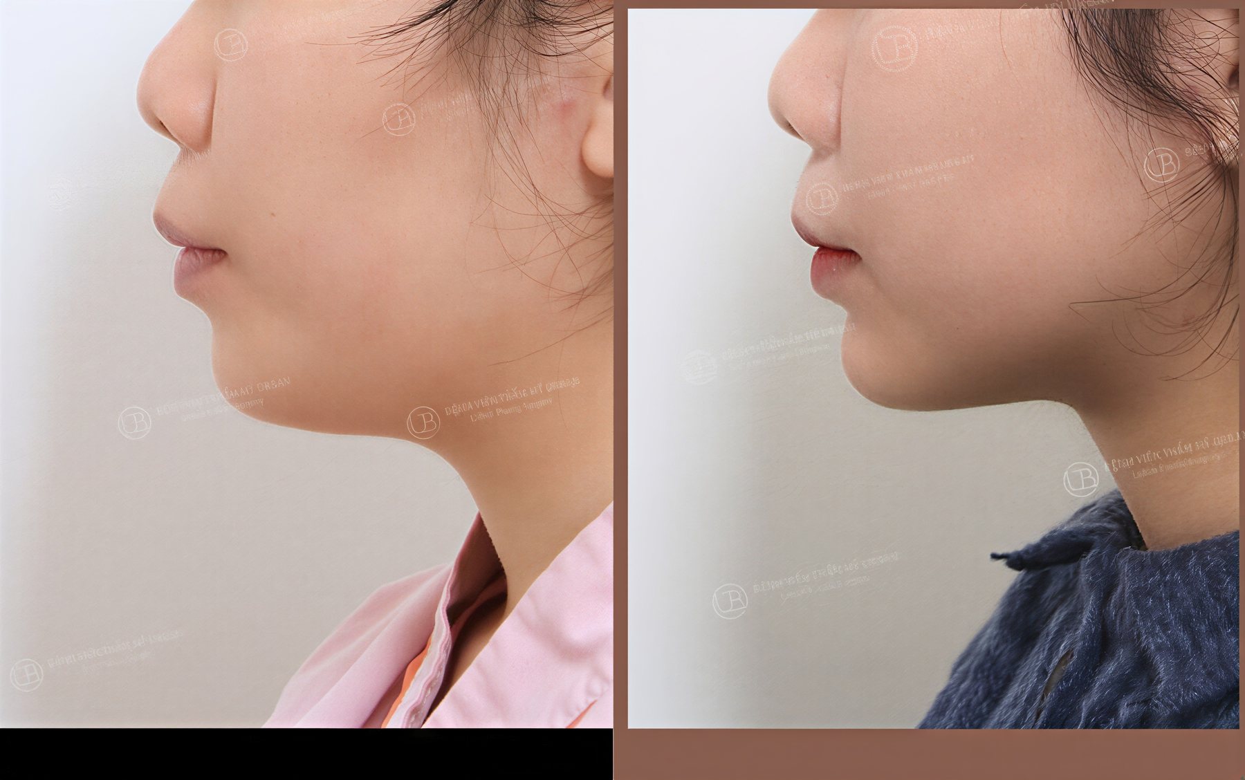 Resultados de liposucción de papada antes y después en URBAN Plastic Surgery, contorno mejorado