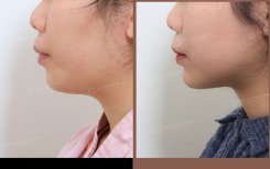 نتيجة شفط دهون الذقن المزدوج قبل وبعد في URBAN Plastic Surgery، تحديد الفك بوضوح