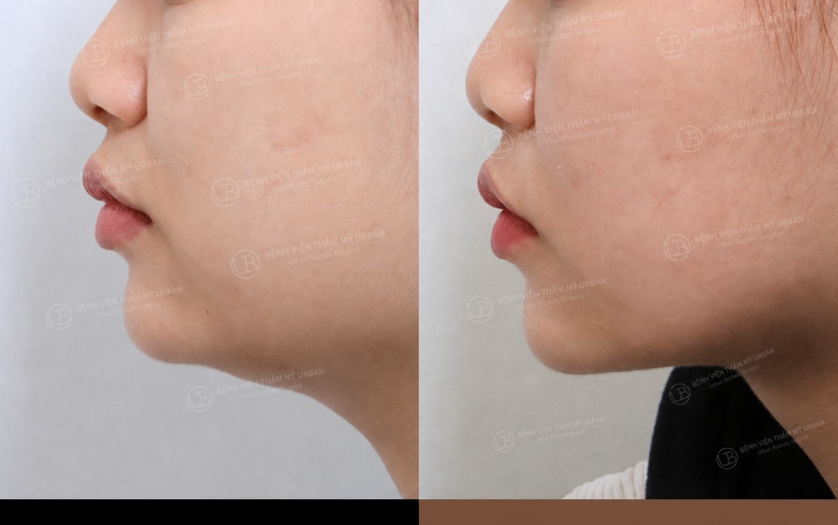 Resultado de liposucción de papada antes y después en URBAN Plastic Surgery, mandíbula definida