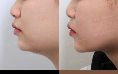 نتيجة شفط دهون الذقن المزدوج قبل وبعد في URBAN Plastic Surgery، تحديد الفك