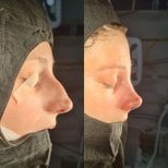 Resultados de rinoplastia antes y después en ÜMRAN TIP MERKEZİ, perfil nasal mejorado