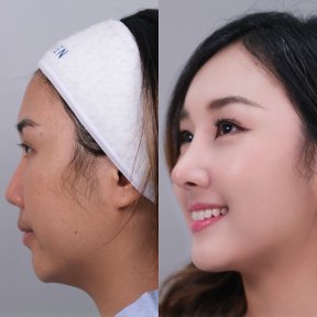 Before and after jawline contouring result at Dr. Chen Surgery Hospital International Center