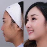 Before and after jawline contouring result at Dr. Chen Surgery Hospital International Center