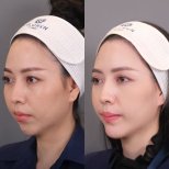Jawline contouring before and after results at Dr. Chen Surgery Hospital International Center