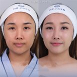 Jawline contouring before and after results at Dr. Chen Surgery Hospital International Center