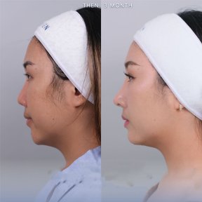 Jawline contouring before and after results at Dr. Chen Surgery Hospital International Center