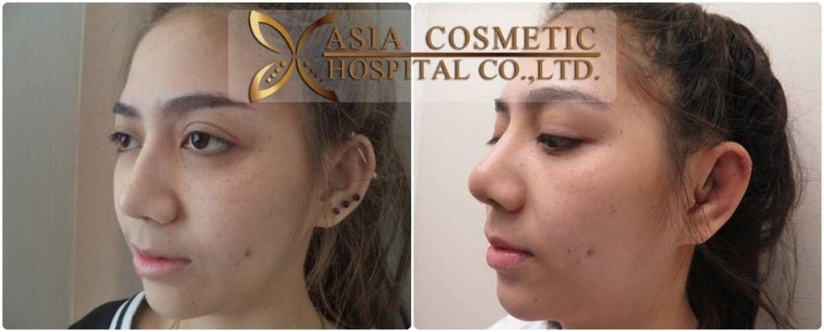 Resultados de otoplastia antes y después en Asia Cosmetic Hospital, orejas de aspecto natural