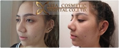Before and after otoplasty results at Asia Cosmetic Hospital, ear reshaping with natural look