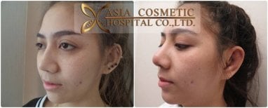 Before and after otoplasty results at Asia Cosmetic Hospital, ear reshaping with natural look