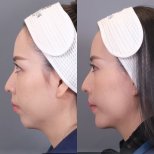 Before and after jawline contouring results at Dr. Chen Surgery Hospital International Center
