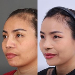 Before and after jawline contouring results at Dr. Chen Surgery Hospital International Center
