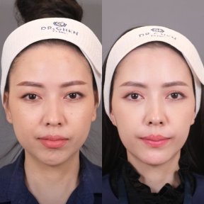 Before and after jawline contouring result at Dr. Chen Surgery Hospital International Center