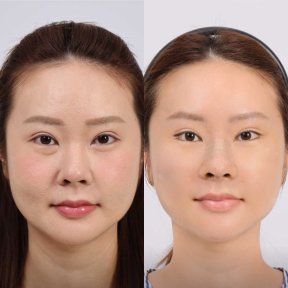 Before and after deep plane facelift results at Dr. Chen Surgery Hospital International Center