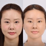 Before and after deep plane facelift results at Dr. Chen Surgery Hospital International Center