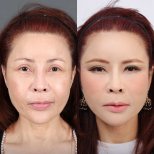 Before and after deep plane facelift results at Dr. Chen Surgery Hospital International Center
