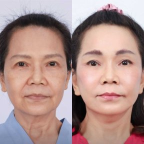 Before and after deep plane facelift results at Dr. Chen Surgery Hospital International Center