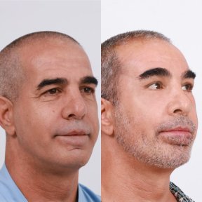Before and after deep plane facelift result at Dr. Chen Surgery Hospital International Center