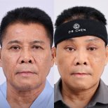 Before and after deep plane facelift result at Dr. Chen Surgery Hospital International Center