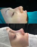 نتائج عملية تجميل الأنف قبل وبعد في ÜMRAN TIP MERKEZİ، تحسين شكل الأنف