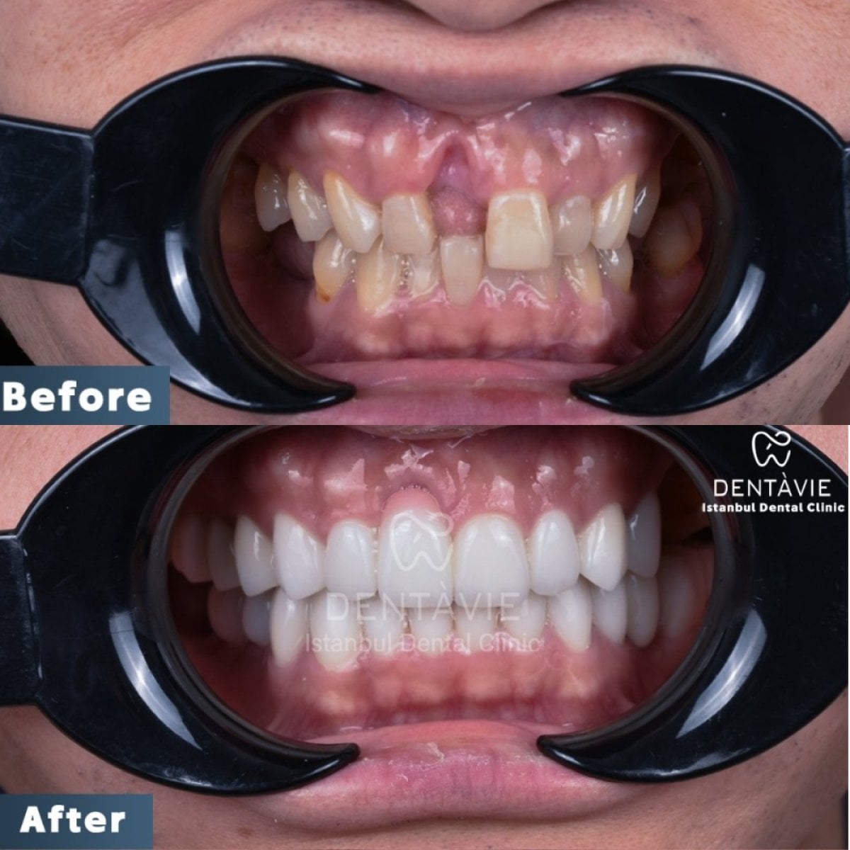 نتائج قبل وبعد ابتسامة هوليود في عيادة Dentavie Istanbul Dental Clinic، تجميل الابتسامة
