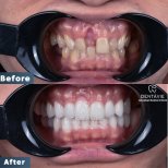Resultados de antes y después de Hollywood Smile en Dentavie Istanbul Dental Clinic, cambio de sonrisa