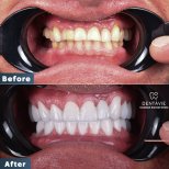 Resultados antes y después de Hollywood Smile en Dentavie Istanbul Dental Clinic, cambio de sonrisa