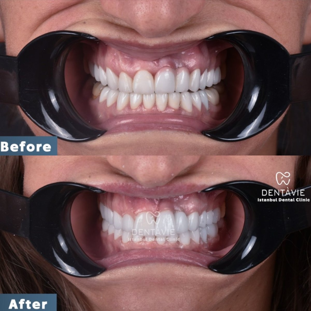 نتائج قبل وبعد ابتسامة هوليود في Dentavie Istanbul Dental Clinic، أسنان أكثر بياضًا
