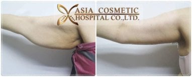 Before and after arm liposuction results at Asia Cosmetic Hospital, improved arm contour