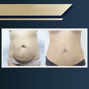 Before and after liposuction results at Asia Cosmetic Hospital, abdomen contour improvement