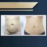Before and after liposuction results at Asia Cosmetic Hospital, abdomen contour improvement