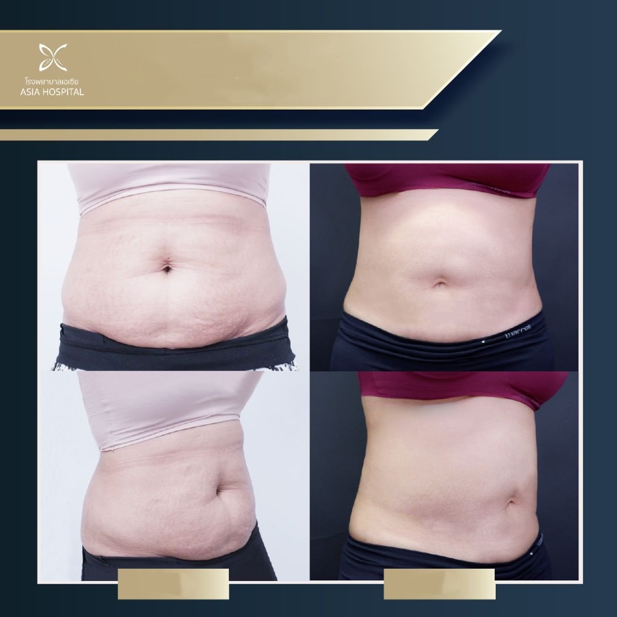 Resultados de liposucción abdominal antes y después en Asia Cosmetic Hospital, contorno visible